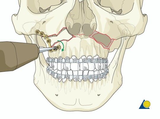 Facial Trauma treatment